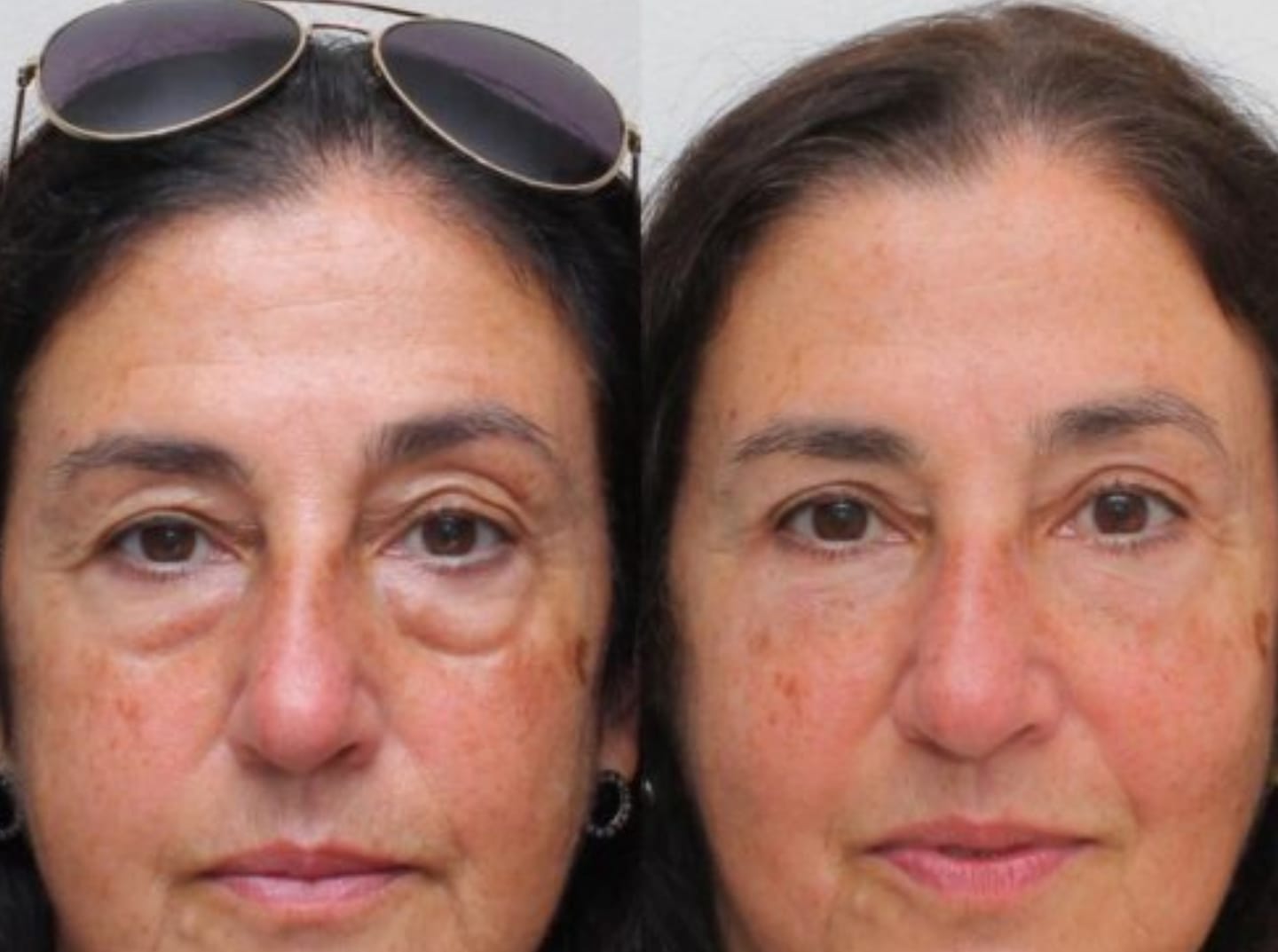 Parches de Microagujas + Ácido hialurónico para ojeras, bolsas y arrugas