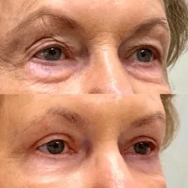 Parches de Microagujas + Ácido hialurónico para ojeras, bolsas y arrugas