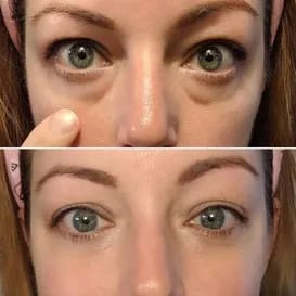 Parches de Microagujas + Ácido hialurónico para ojeras, bolsas y arrugas