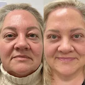 Parches de Microagujas + Ácido hialurónico para ojeras, bolsas y arrugas
