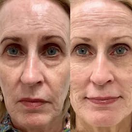 Parches de Microagujas + Ácido hialurónico para ojeras, bolsas y arrugas