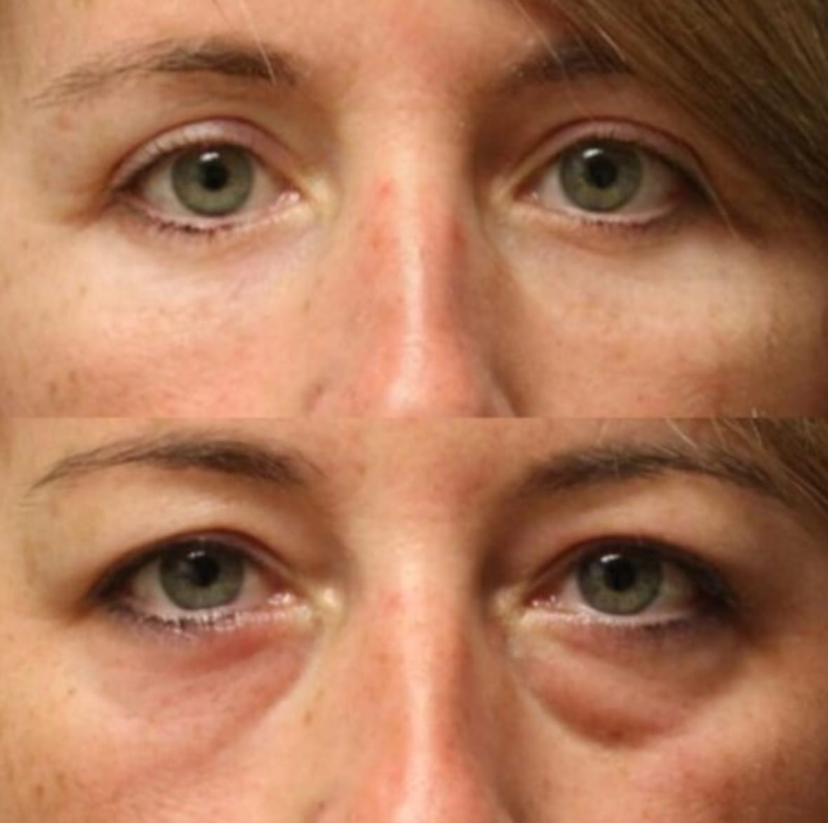 Parches de Microagujas + Ácido hialurónico para ojeras, bolsas y arrugas